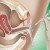 Tip #88: Intrauterine Insemination – IUI